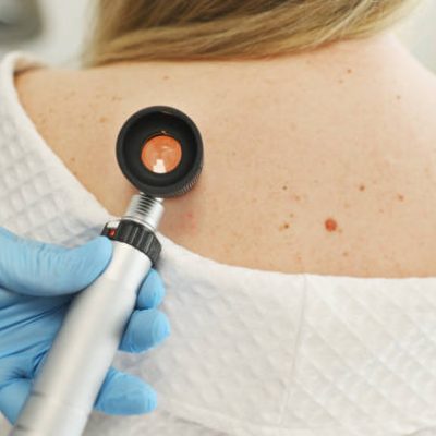 close-up - a dermatologist examines moles and skin growths on the patient's body using a special device - a dermatoscope. Diagnosis and prevention of melanoma.